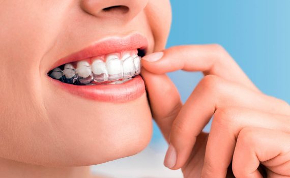 Tratamiento de ortodoncia Invisalign, más ventajas y eficacia