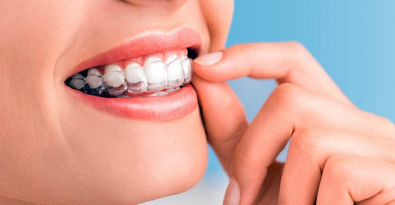 Ortodoncia Invisalign Tratamiento de ortodoncia Invisalign, más ventajas y eficacia