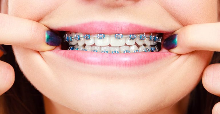 Tipos ortodoncia Castellón El mejor tratamiento para corregir tus dientes torcidos