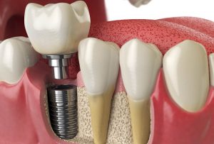 Implante dental Castellón