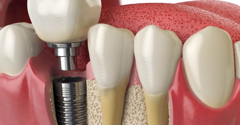 Implante dental Castellón Reemplaza los dientes perdidos con implantes dentales