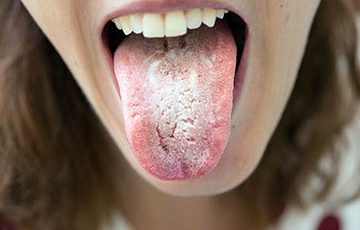 Lengua blanca, origen de la halitosis Tu lengua blanca puede indicar problemas de salud