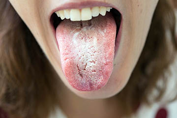 Tu lengua blanca puede indicar problemas de salud