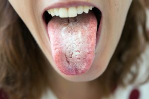 Lengua blanca, origen de la halitosis