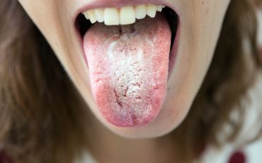 Lengua blanca, origen de la halitosis Tu lengua blanca puede indicar problemas de salud
