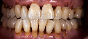 Raspado dental después