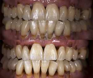Tratamiento raspado de dientes