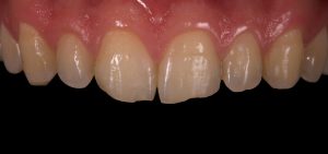 Tratamiento blanqueamiento dental Castellón
