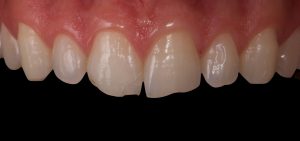 Blanqueamiento dental Castellón