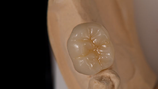 Periodoncia dental clínica dental Castellón