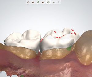 Periodoncia dental dentista Castellón